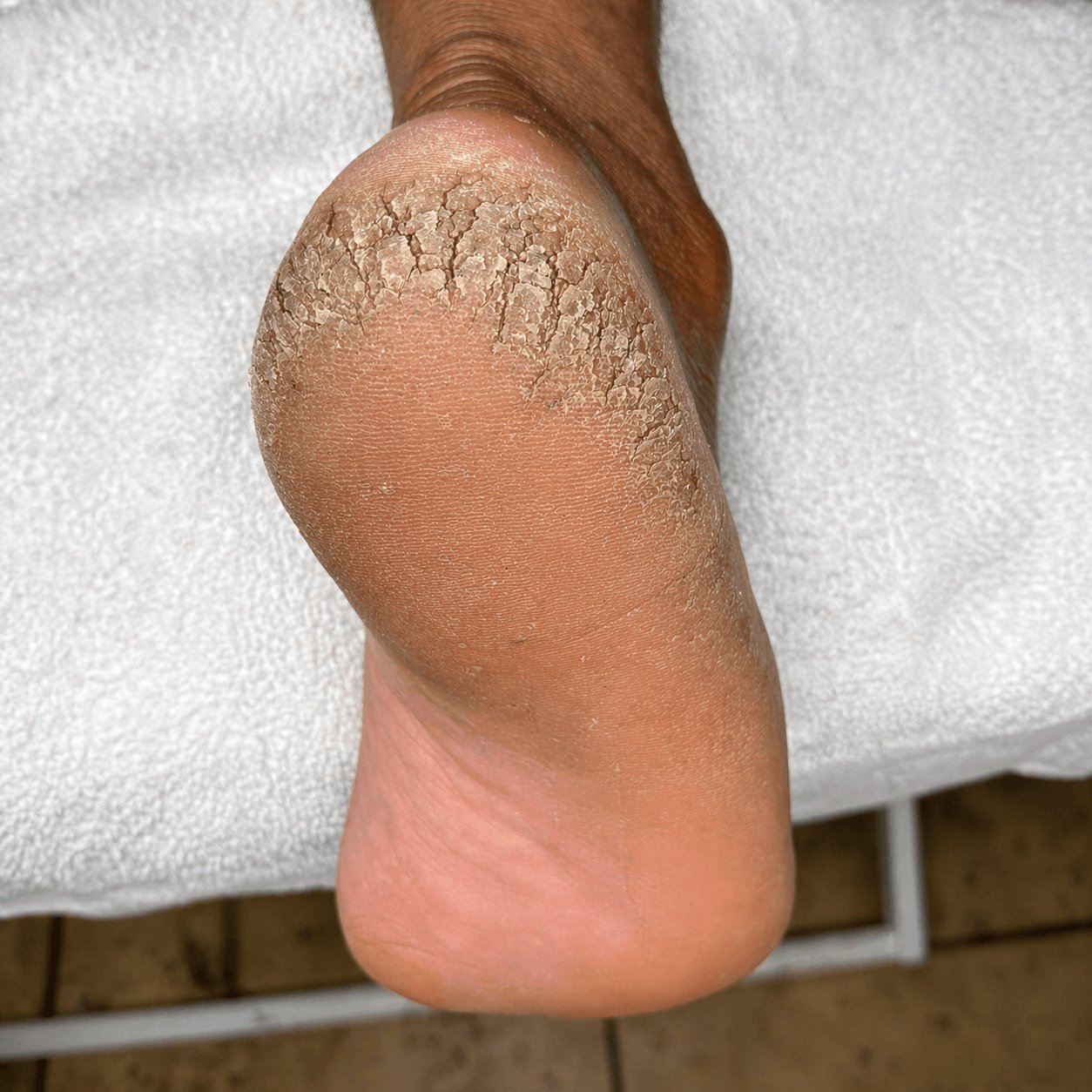 Pé antes da transformação podal