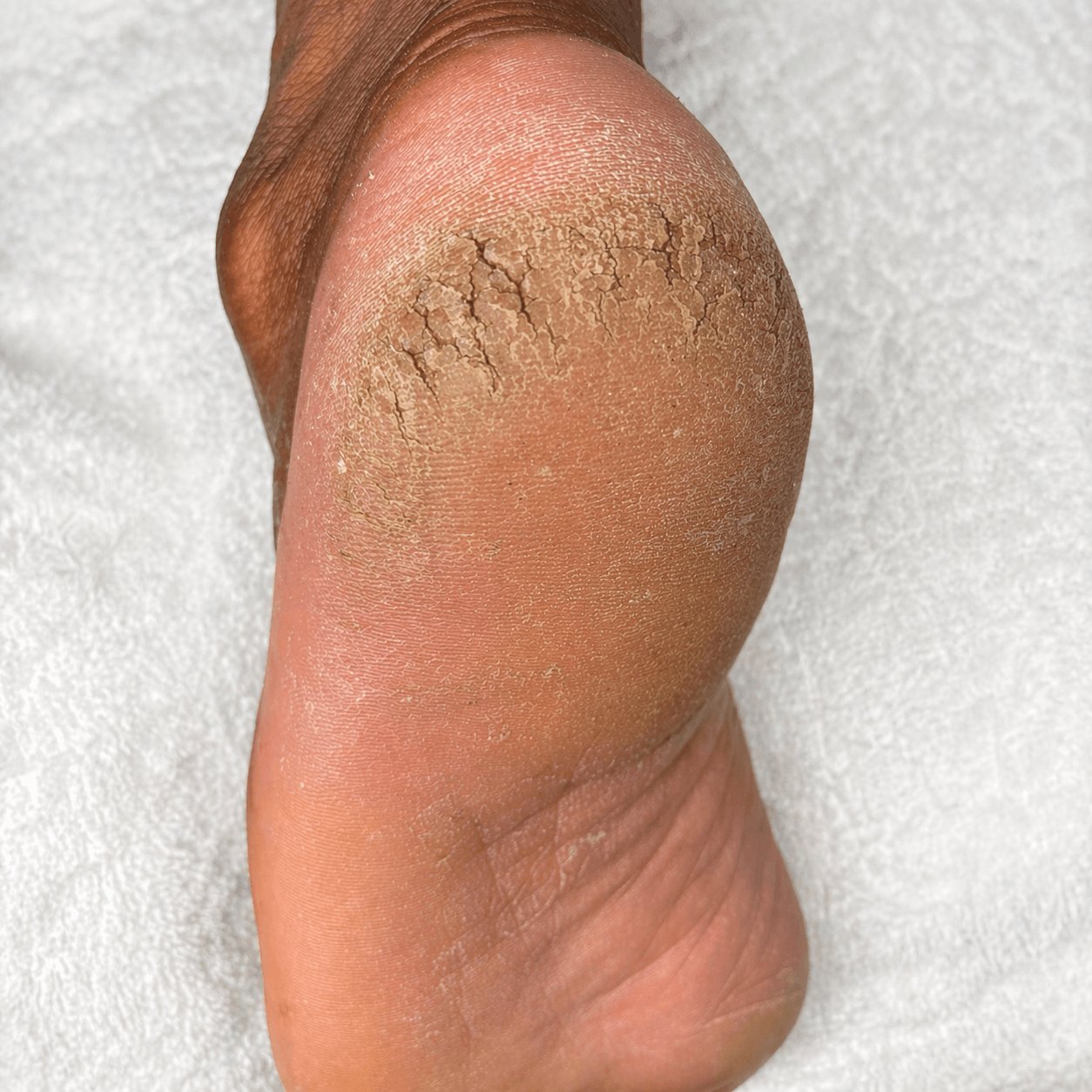 Pé antes da transformação podal